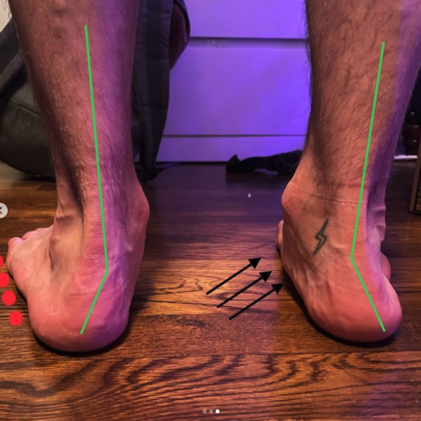 fallen arch feet